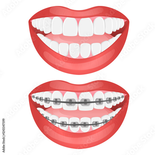 Vector image of mouth and teeth. Braces and bite correction. Dentistry and dental treatment concept. Element for your design of banners, posters, articles, etc.