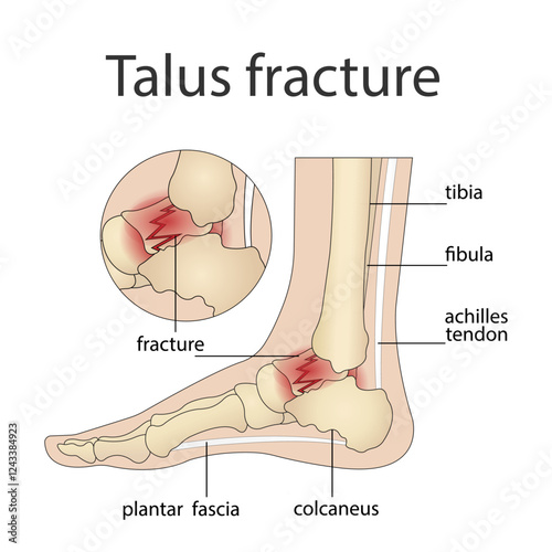 Illustration of bone fractures. The anatomical structure of the human foot with a painful part