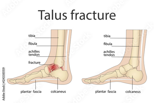 Illustration of bone fractures. Anatomical structure of the human foot with a painful part