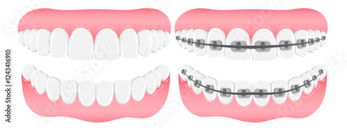 Vector image of mouth and teeth. Braces and bite correction. Dentistry and dental treatment concept. Element for your design of banners, posters, articles, etc.