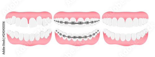 Vector image of mouth and teeth. Braces and bite correction. Dentistry and dental treatment concept. Element for your design of banners, posters, articles, etc.