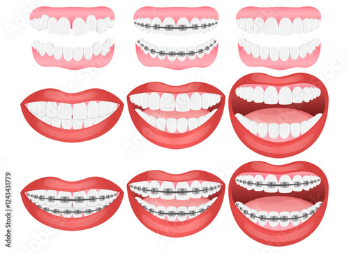 Vector image of mouth and teeth. Braces and bite correction. Dentistry and dental treatment concept. Element for your design of banners, posters, articles, etc.