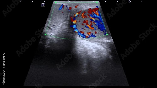 Orchitis testicle infection, ultrasound scan