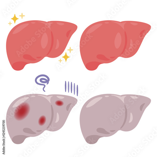 健康でキレイな肝臓と炎症が起きた不健康な肝臓のイラスト