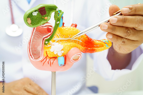 Pancreatitis, pancreatic cancer, Asian doctor with pancreas, gallbladder and bile duct human anatomy model at hospital.