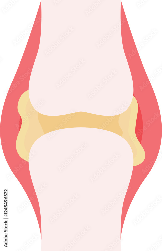 Naklejka premium Chronic Tophaceous Gout