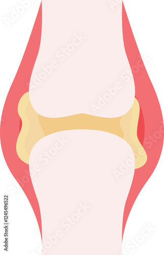 Chronic Tophaceous Gout
