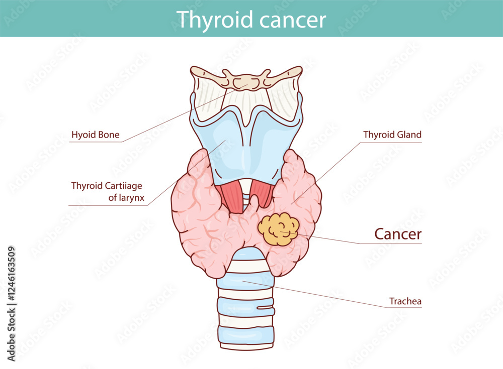 Obraz premium Thyroid cancer. Vector anatomical illustration hand drawn in cartoon style.