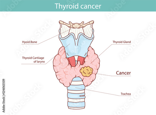 Thyroid cancer. Vector anatomical illustration hand drawn in cartoon style.