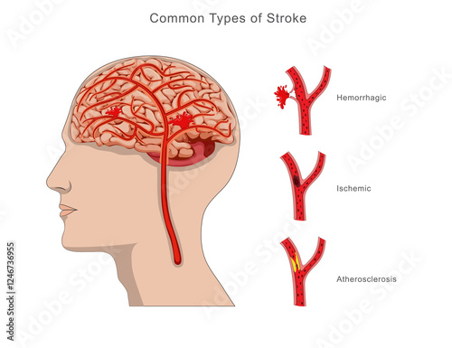 Illustration of common types of brain stroke, including ischemic, hemorrhagic, and transient ischemic attack, highlighting causes, effects, and differences in brain function