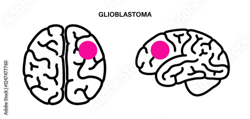 Glioblastoma brain cancer
