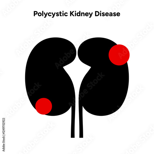 Kidney cysts polycystic urinary disease. Renal cysts of fluid in the kidneys. Medical diagram illustration 