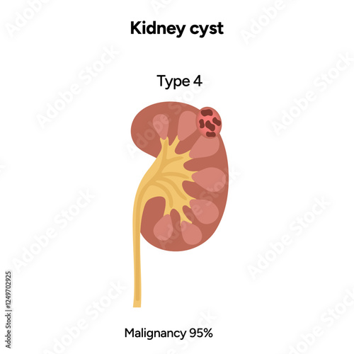 Kidney cysts urinary disease. Renal cysts of fluid in the kidneys. Medical diagram illustration. Type 4