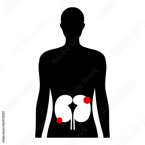 Kidney cysts polycystic urinary disease. Renal cysts of fluid in the kidneys. Medical diagram illustration  