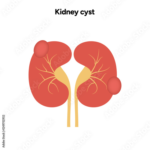 Kidney cysts polycystic urinary disease. Renal cysts of fluid in the kidneys. Medical diagram illustration 