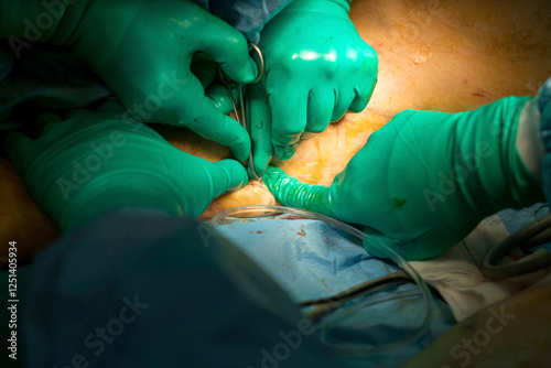 Process of varicose vein surgery in hospital, vein sealing, venous vascular surgery, phlebectomy surgery, surgical field marking, superficial veins problems, swollen skin, step by step photo