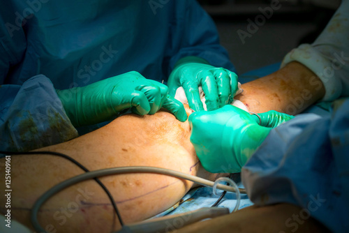 Process of varicose vein surgery in hospital, vein sealing, venous vascular surgery, phlebectomy surgery, surgical field marking, superficial veins problems, swollen skin, step by step