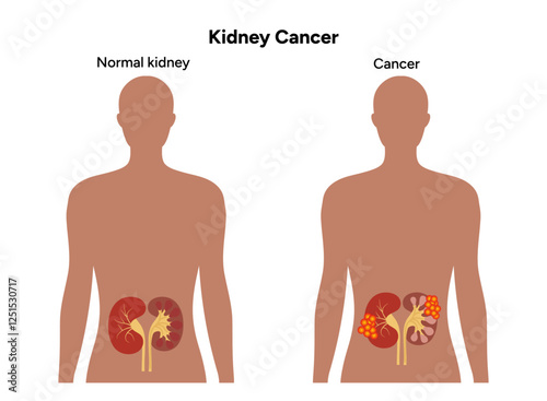 Kidney cancer disease Process in human. Medical problem Diagram