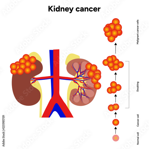 Kidney cancer disease Process in human. Medical problem Diagram