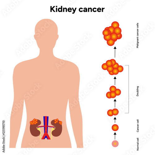 Kidney cancer disease Process in human. Medical problem Diagram