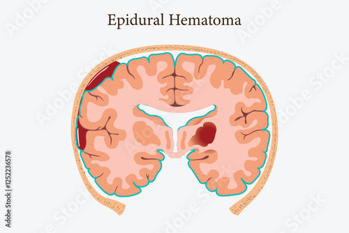 Neurology infographic depicting different types of traumatic brain injuries.