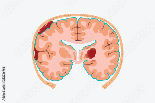 Educational brain anatomy chart showing hematoma locations and hemorrhage classifications.
