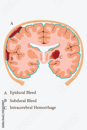 Anatomical depiction of brain bleeding types: epidural, subdural, and intracerebral hematomas.