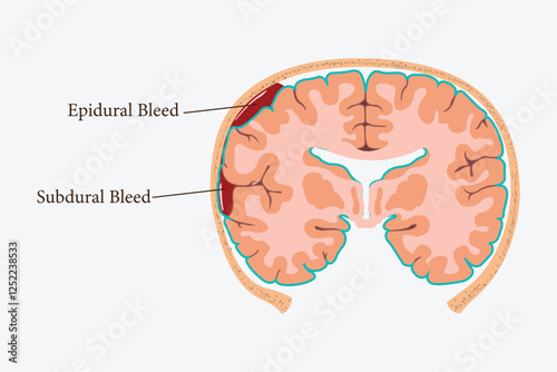 Medical illustration of epidural hematoma showing brain hemorrhage types with labeled sections. EPS 10