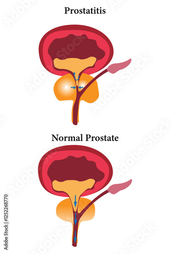 Anatomical diagram showing inflamed prostate vs. healthy prostate with urinary tract effects.