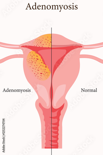 Medical illustration comparing adenomyosis and normal uterus structure.