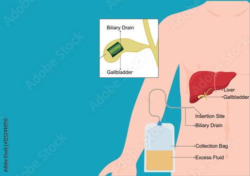 A biliary drain allows bile.