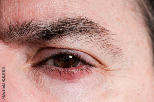 Photos Man suffering from blepharitis showing red and inflamed eyelid