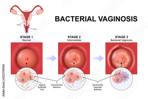 Bacterial vaginosis (BV) vaginal infection illustration