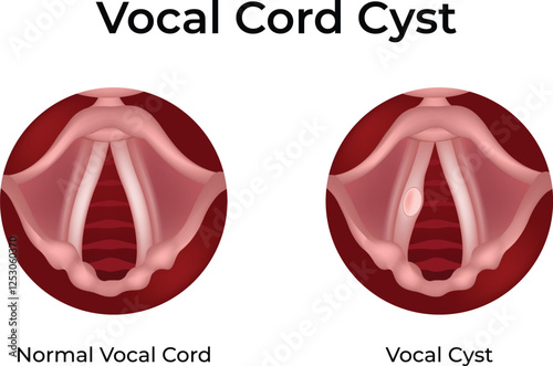 Vocal Cord Cyst Normal vs Affected Design Vector Illustration