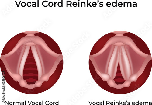 Vocal Cord Reinke's Edema Design Vector Illustration