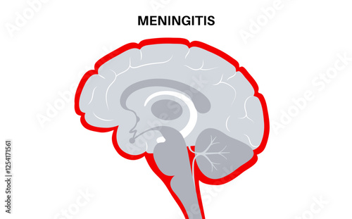 Meningitis medical poster