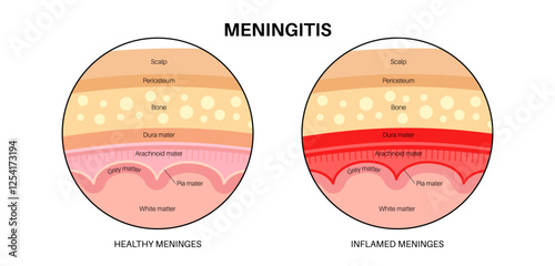 Meningitis medical poster