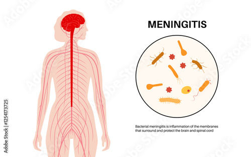 Meningitis medical poster