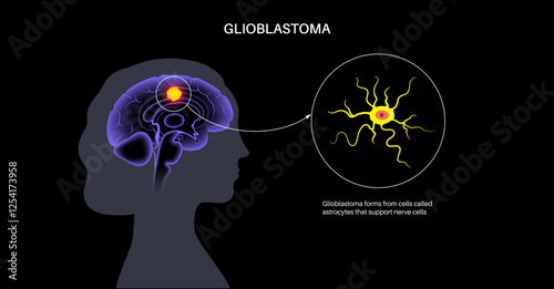 Glioblastoma brain cancer