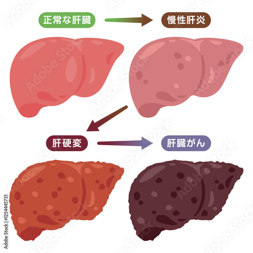 肝臓がんになる過程イラスト
