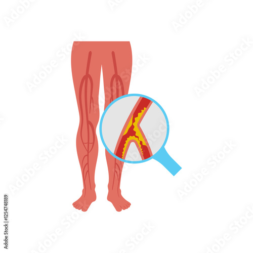 Peripheral Artery Disease, Cardiovascular Disease Illustration Icon