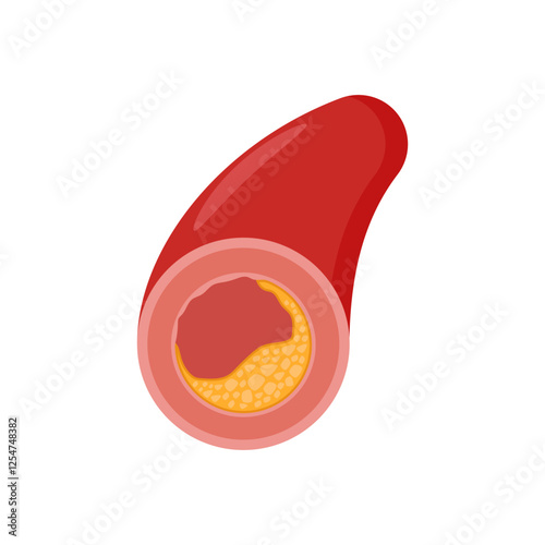 Atherosclerosis, Cardiovascular Disease Illustration Icon