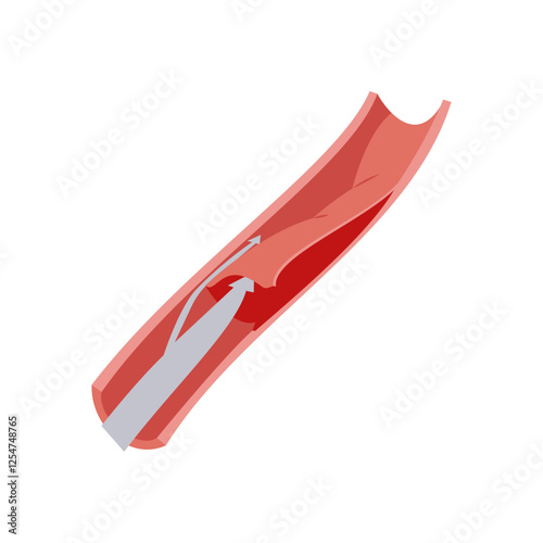 Intimal Tear, Cardiovascular Disease Illustration Icon