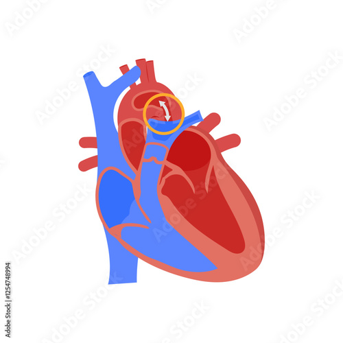 Patent Ductus Arteriosus, Cardiovascular Disease Illustration Icon photo