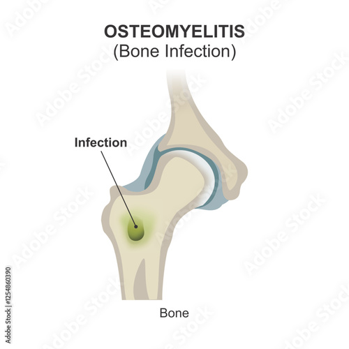 Osteomyelitis (Bone Infection) Illustration