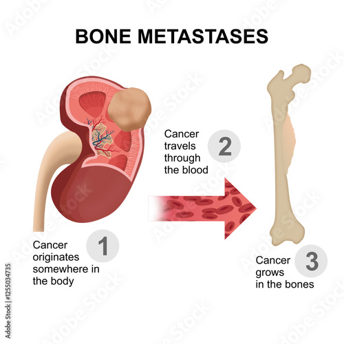 Bone Metastases cancer spreading through blood illustration