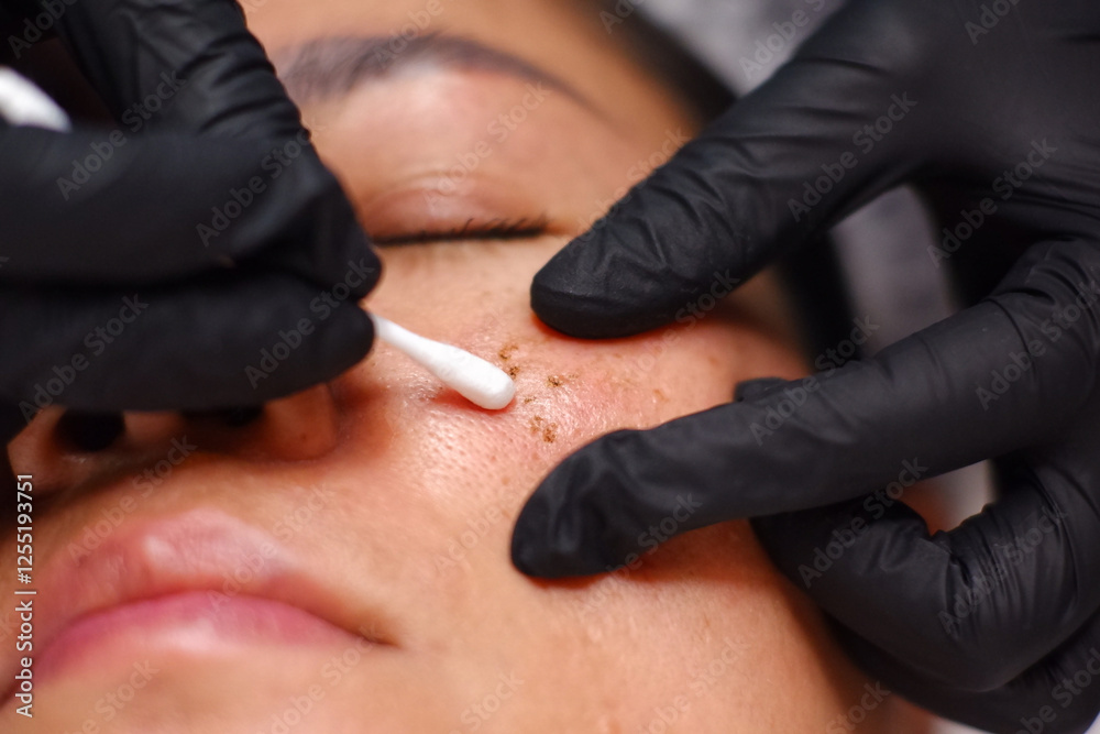 Fototapeta premium Freckles, laser plasma removal