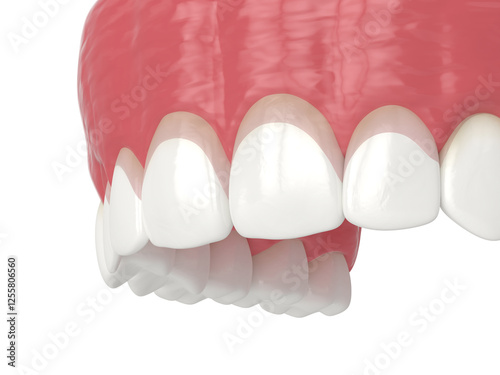 3d render of upper jaw with gummy smile and corrected gum line. Gingivectomy treatment concept.