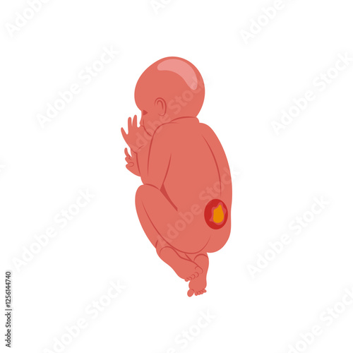 Spina, Bifida, Disability Vector Illustration Isolated