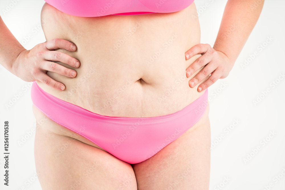 Tummy tuck, flabby skin with stretch marks on a fat belly, plastic surgery concept on gray background Tummy tuck, flabby skin with stretch marks on a fat belly, plastic surgery concept on gray background